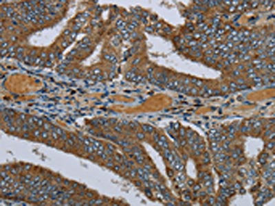 The image on the left is immunohistochemistry of paraffin-embedded Human colon cancer tissue using PCK2 Antibody(PCK2 Antibody) at dilution 1/60, on the right is treated with fusion protein. (Original magnification: ×200)Rabbit anti-Human PCK2 Polyclonal Antibody