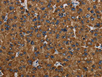 The image on the left is immunohistochemistry of paraffin-embedded Human liver cancer tissue using the antibody Antibody) at dilution 1/60, on the right is treated with fusion protein. (Original magnification: ×200)Rabbit anti-Human PCK2 Polyclonal Antibody