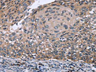 The image on the left is immunohistochemistry of paraffin-embedded Human cervical cancer tissue using RNF144B Antibody(RNF144B Antibody) at dilution 1/50, on the right is treated with fusion protein. (Original magnification: ×200)Rabbit anti-Human RNF144B Polyclonal Antibody