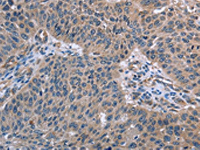 The image on the left is immunohistochemistry of paraffin-embedded Human lung cancer tissue using the antibody Antibody) at dilution 1/50, on the right is treated with fusion protein. (Original magnification: ×200)Rabbit anti-Human RNF144B Polyclonal Antibody
