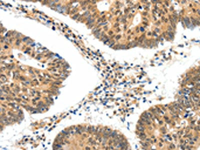 The image on the left is immunohistochemistry of paraffin-embedded Human colon cancer tissue using SSTR5 Antibody(SSTR5 Antibody) at dilution 1/30, on the right is treated with synthetic peptide. (Original magnification: ×200)Rabbit anti-Human SSTR5 Polyclonal Antibody