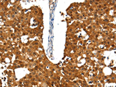 The image on the left is immunohistochemistry of paraffin-embedded Human breast cancer tissue using the antibody Antibody) at dilution 1/30, on the right is treated with synthetic peptide. (Original magnification: ×200)Rabbit anti-Human SSTR5 Polyclonal Antibody