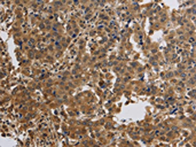The image on the left is immunohistochemistry of paraffin-embedded Human liver cancer tissue using the antibody Antibody) at dilution 1/40, on the right is treated with synthetic peptide. (Original magnification: ×200)