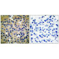 Immunohistochemical analysis of paraffin-embedded human breast carcinoma tissue using Collagen II antibody.Rabbit anti-Human COL2A1 Polyclonal Antibody