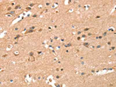 The image on the left is immunohistochemistry of paraffin-embedded Human brain  tissue using CRELD1 Antibody(CRELD1 Antibody) at dilution 1/40, on the right is treated with synthetic peptide. (Original magnification: ×200)Rabbit anti-Human CRELD1 Polyclonal Antibody