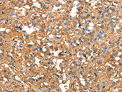 The image on the left is immunohistochemistry of paraffin-embedded Human thyroid cancer tissue using the antibody Antibody) at dilution 1/40, on the right is treated with synthetic peptide. (Original magnification: ×200)Rabbit anti-Human CRELD1 Polyclonal Antibody