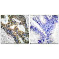 Immunohistochemical analysis of paraffin-embedded human colon carcinoma tissue using MMP-7 antibody.Rabbit anti-Human MMP7 Polyclonal Antibody