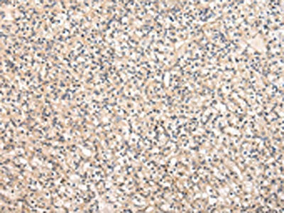 The image on the left is immunohistochemistry of paraffin-embedded Human prostate cancer tissue using VPS37A Antibody(VPS37A Antibody) at dilution 1/30, on the right is treated with fusion protein. (Original magnification: ×200)Rabbit anti-Human VPS37A Polyclonal Antibody
