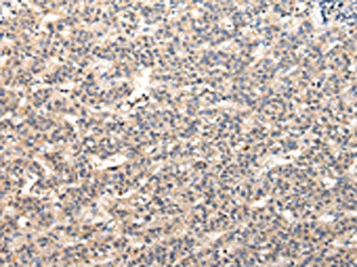 The image on the left is immunohistochemistry of paraffin-embedded Human liver cancer tissue using the antibody Antibody) at dilution 1/30, on the right is treated with fusion protein. (Original magnification: ×200)Rabbit anti-Human VPS37A Polyclonal Antibody