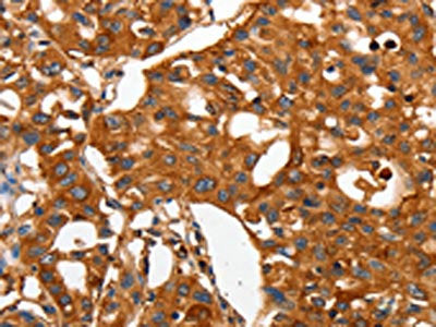 The image on the left is immunohistochemistry of paraffin-embedded Human lung cancer tissue using the antibody Antibody) at dilution 1/50, on the right is treated with fusion protein. (Original magnification: ×200)