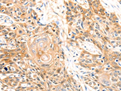 The image on the left is immunohistochemistry of paraffin-embedded Human esophagus cancer tissue using CA2 Antibody(CA2 Antibody) at dilution 1/20, on the right is treated with fusion protein. (Original magnification: ×200)