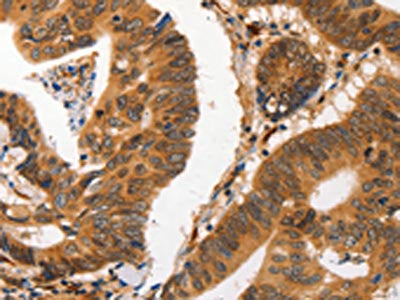 The image on the left is immunohistochemistry of paraffin-embedded Human colon cancer tissue using the antibody Antibody) at dilution 1/20, on the right is treated with fusion protein. (Original magnification: ×200)
