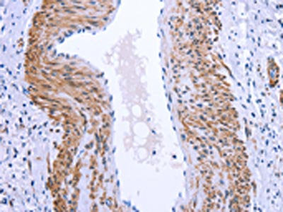 The image on the left is immunohistochemistry of paraffin-embedded Human cervical cancer tissue using GPR171 Antibody(GPR171 Antibody) at dilution 1/25, on the right is treated with synthetic peptide. (Original magnification: ×200)