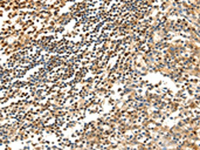 The image on the left is immunohistochemistry of paraffin-embedded Human tonsil tissue using SCTR Antibody(SCTR Antibody) at dilution 1/40, on the right is treated with synthetic peptide. (Original magnification: ×200)Rabbit anti-Human SCTR Polyclonal Antibody