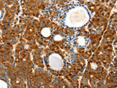 The image on the left is immunohistochemistry of paraffin-embedded Human thyroid cancer tissue using the antibody Antibody) at dilution 1/40, on the right is treated with synthetic peptide. (Original magnification: ×200)Rabbit anti-Human SCTR Polyclonal Antibody