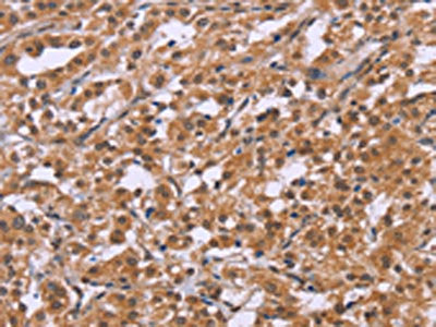 The image on the left is immunohistochemistry of paraffin-embedded Human thyroid cancer tissue using CRH Antibody(CRH Antibody) at dilution 1/20, on the right is treated with synthetic peptide. (Original magnification: x200)Rabbit anti-Human CRH Polyclonal Antibody