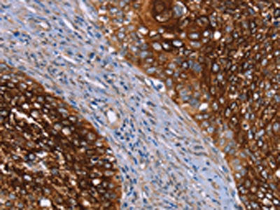 The image on the left is immunohistochemistry of paraffin-embedded Human cervical cancer tissue using the antibody Antibody) at dilution 1/20, on the right is treated with synthetic peptide. (Original magnification: x200)Rabbit anti-Human CRH Polyclonal Antibody