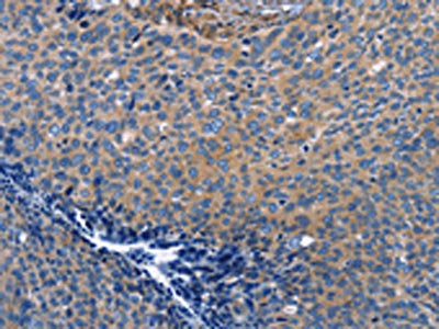 The image on the left is immunohistochemistry of paraffin-embedded Human cervical cancer tissue using INTS10 Antibody(INTS10 Antibody) at dilution 1/50, on the right is treated with fusion protein. (Original magnification: ×200)