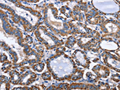 The image on the left is immunohistochemistry of paraffin-embedded Human thyroid cancer tissue using the antibody Antibody) at dilution 1/50, on the right is treated with fusion protein. (Original magnification: ×200)