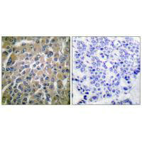 Immunohistochemical analysis of paraffin-embedded human breast carcinoma tissue using hCG β antibody.Rabbit anti-Human CGB Polyclonal Antibody