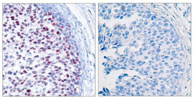 Immunohistochemical analysis of paraffin-embedded human breast carcinoma tissue using c-Jun(Phospho-Thr239) Antibody(left) or the same antibody preincubated with blocking peptide(right).