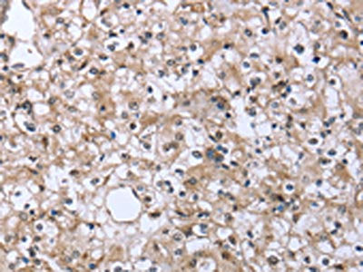 The image on the left is immunohistochemistry of paraffin-embedded Human prostate cancer tissue using FCAR Antibody(FCAR Antibody) at dilution 1/20, on the right is treated with fusion protein. (Original magnification: ×200)Rabbit anti-Human FCAR Polyclonal Antibody