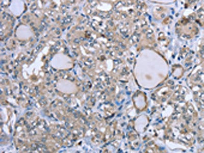The image on the left is immunohistochemistry of paraffin-embedded Human thyroid cancer tissue using the antibody Antibody) at dilution 1/20, on the right is treated with fusion protein. (Original magnification: ×200)Rabbit anti-Human FCAR Polyclonal Antibody