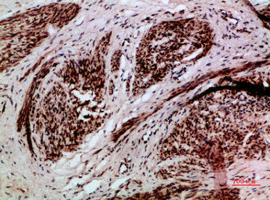 Immunohistochemical analysis of paraffin-embedded human-cervical-cancer, antibody was diluted at 1:200Rabbit anti-Human TMPO/TMPO Polyclonal Antibody