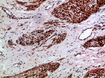 Immunohistochemical analysis of paraffin-embedded human-cervical-cancer, antibody was diluted at 1:200Rabbit anti-Human TMPO/TMPO Polyclonal Antibody