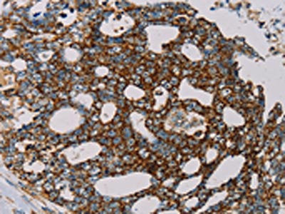 The image on the left is immunohistochemistry of paraffin-embedded Human cervical cancer tissue using MRPL12 Antibody(MRPL12 Antibody) at dilution 1/20, on the right is treated with fusion protein. (Original magnification: ×200)Rabbit anti-Human MRPL12 Polyclonal Antibody