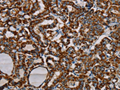The image on the left is immunohistochemistry of paraffin-embedded Human thyroid cancer tissue using the antibody Antibody) at dilution 1/20, on the right is treated with fusion protein. (Original magnification: ×200)