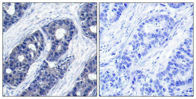 Immunohistochemical analysis of paraffin-embedded human breast carcinoma tissue using IRS-1(Ab-636) Antibody(left) or the same antibody preincubated with blocking peptide(right).