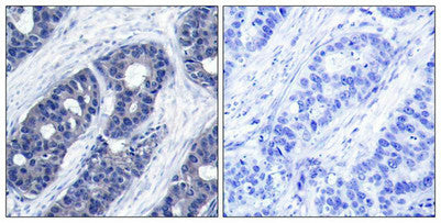 Immunohistochemical analysis of paraffin-embedded human breast carcinoma tissue using IRS-1(Ab-636) Antibody(left) or the same antibody preincubated with blocking peptide(right).