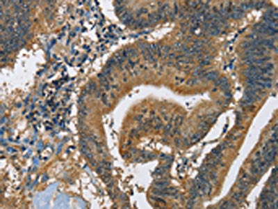 The image on the left is immunohistochemistry of paraffin-embedded Human colon cancer tissue using CAST Antibody(CAST Antibody) at dilution 1/60, on the right is treated with fusion protein. (Original magnification: ×200)