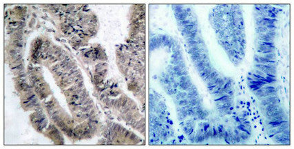 Immunohistochemical analysis of paraffin-embedded human colon carcinoma tissue using AMPKa1(Phospho-Ser487)Antibody(left) or the same antibody preincubated with blocking peptide(right).Rabbit anti-Human PRKAA1/PRKAA2 Polyclonal Antibody
