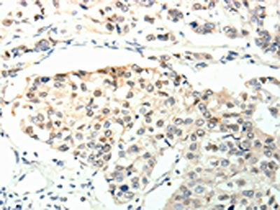 The image on the left is immunohistochemistry of paraffin-embedded Human breast cancer tissue using TPM2 Antibody(TPM2 Antibody) at dilution 1/60, on the right is treated with synthetic peptide. (Original magnification: ×200)Rabbit anti-Human TPM2 Polyclonal Antibody
