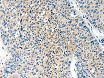The image on the left is immunohistochemistry of paraffin-embedded Human liver cancer tissue using the antibody Antibody) at dilution 1/60, on the right is treated with synthetic peptide. (Original magnification: ×200)Rabbit anti-Human TPM2 Polyclonal Antibody