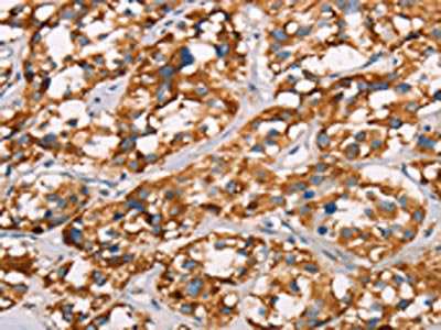 The image on the left is immunohistochemistry of paraffin-embedded Human thyroid cancer tissue using SPR Antibody(SPR Antibody) at dilution 1/40, on the right is treated with synthetic peptide. (Original magnification: ×200)Rabbit anti-Human SPR Polyclonal Antibody