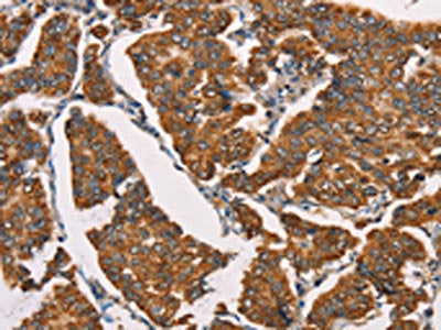 The image on the left is immunohistochemistry of paraffin-embedded Human breast cancer tissue using the antibody Antibody) at dilution 1/40, on the right is treated with synthetic peptide. (Original magnification: ×200)Rabbit anti-Human SPR Polyclonal Antibody
