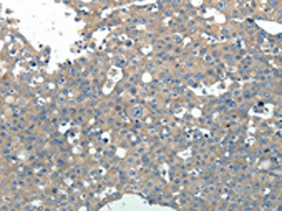 The image on the left is immunohistochemistry of paraffin-embedded Human breast cancer tissue using PVALB Antibody(PVALB Antibody) at dilution 1/20, on the right is treated with fusion protein. (Original magnification: ×200)Rabbit anti-Human PVALB Polyclonal Antibody