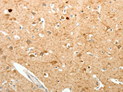 The image on the left is immunohistochemistry of paraffin-embedded Human brain tissue using the antibody Antibody) at dilution 1/20, on the right is treated with fusion protein. (Original magnification: ×200)Rabbit anti-Human PVALB Polyclonal Antibody