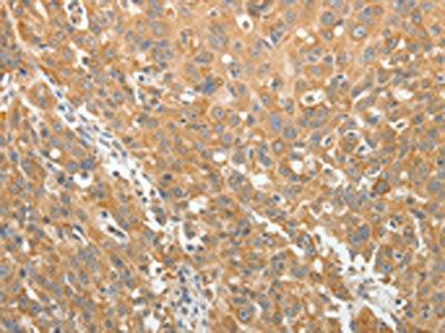 The image on the left is immunohistochemistry of paraffin-embedded Human ovarian cancer tissue using AKR1B1 Antibody(AKR1B1 Antibody) at dilution 1/30, on the right is treated with synthetic peptide. (Original magnification: ×200)Rabbit anti-Human AKR1B1 Polyclonal Antibody