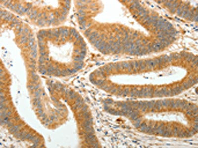 The image on the left is immunohistochemistry of paraffin-embedded Human colon cancer tissue using the antibody Antibody) at dilution 1/30, on the right is treated with synthetic peptide. (Original magnification: ×200)Rabbit anti-Human AKR1B1 Polyclonal Antibody