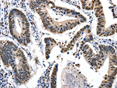 The image on the left is immunohistochemistry of paraffin-embedded Human colon cancer tissue using KLK7 Antibody(KLK7 Antibody) at dilution 1/10, on the right is treated with fusion protein. (Original magnification: ×200)