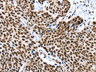 The image on the left is immunohistochemistry of paraffin-embedded Human esophagus cancer tissue using the antibody Antibody) at dilution 1/10, on the right is treated with fusion protein. (Original magnification: ×200)