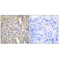 Immunohistochemistry analysis of paraffin-embedded human liver carcinoma tissue using LAMB1 antibody.