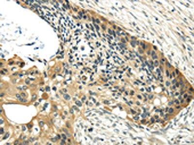 The image on the left is immunohistochemistry of paraffin-embedded Human esophagus cancer tissue using UBL4A Antibody(UBL4A Antibody) at dilution 1/40, on the right is treated with fusion protein. (Original magnification: ×200)Rabbit anti-Human UBL4A Polyclonal Antibody
