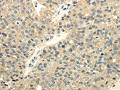 The image on the left is immunohistochemistry of paraffin-embedded Human breast cancer tissue using the antibody Antibody) at dilution 1/40, on the right is treated with fusion protein. (Original magnification: ×200)Rabbit anti-Human UBL4A Polyclonal Antibody