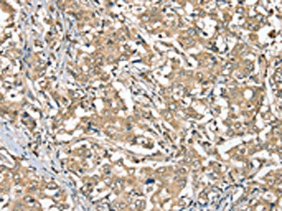 The image on the left is immunohistochemistry of paraffin-embedded Human liver cancer tissue using SGPL1 Antibody(SGPL1 Antibody) at dilution 1/40, on the right is treated with synthetic peptide. (Original magnification: ×200)Rabbit anti-Human SGPL1 Polyclonal Antibody