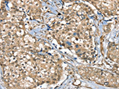 The image on the left is immunohistochemistry of paraffin-embedded Human breast cancer tissue using the antibody Antibody) at dilution 1/40, on the right is treated with synthetic peptide. (Original magnification: ×200)Rabbit anti-Human SGPL1 Polyclonal Antibody